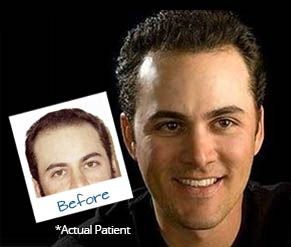 Robotic FUE Hair Transplant before and after photos