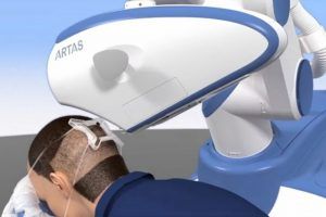 ARTAS Robotic Hair Restoration